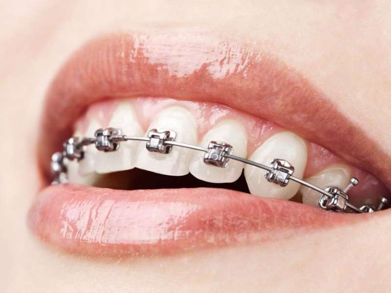 Çapraşık Dişlerin Düzeltilmesi Gerekir Mi?