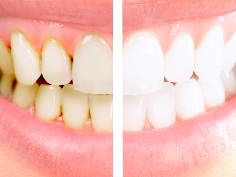 Beyazlatma (Bleaching) İşleminin Dişlere Zararı Var Mıdır?