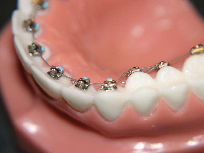 Çapraşık Dişlerin Tedavi Yöntemleri Nelerdir?