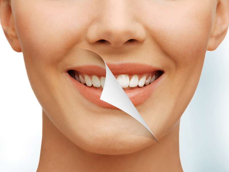 Laminate Diş Kaplama Hangi Durumlarda Uygulanır?