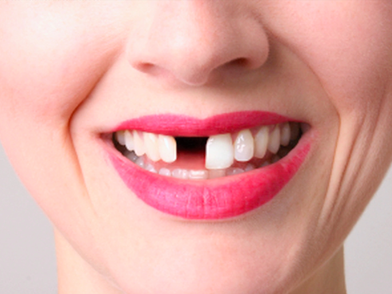 Eksik Dişler Ağızda Ne Gibi Zarara Yol Açar?