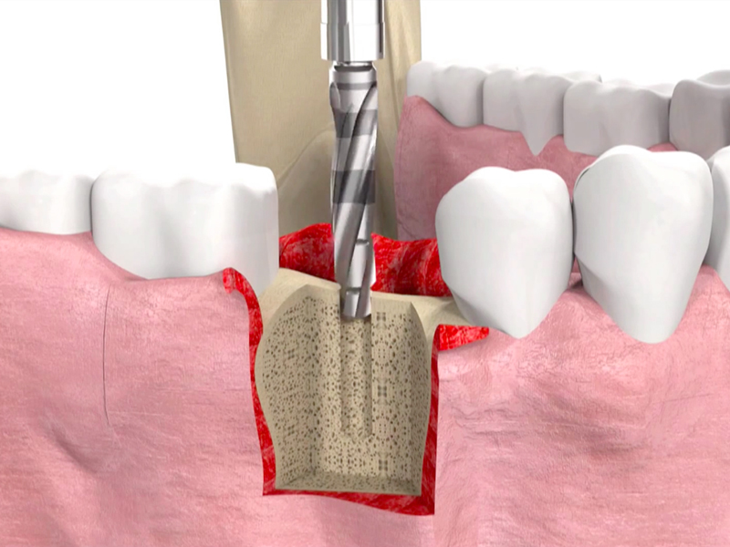 How long does implant treatment last?