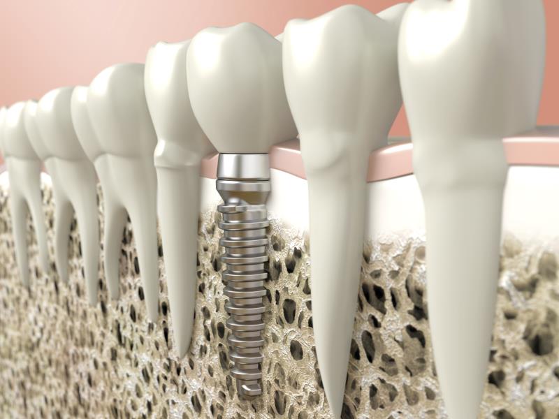 Is the implant treatment safe?