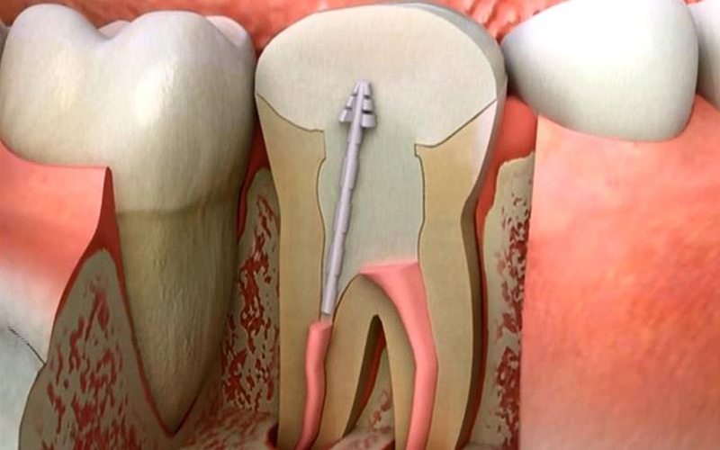 Is root canal treatment a long-lasting treatment?